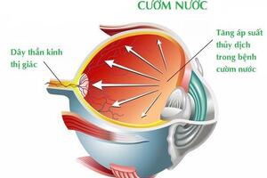 Phẫu thuật glaucoma với thiết bị mini ex-press