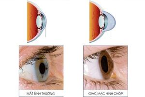 BỆNH ĐỤC THỦY TINH THỂ NGƯỜI GIÀ