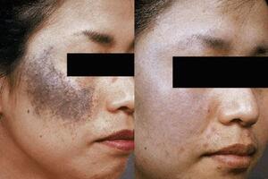BỚT OTA VÀ PHƯƠNG PHÁP ĐIỀU TRỊ