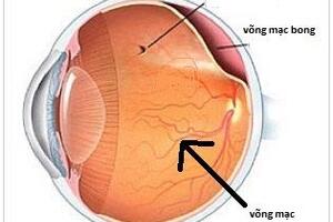 Bong Võng Mạc Cận Thị Nặng